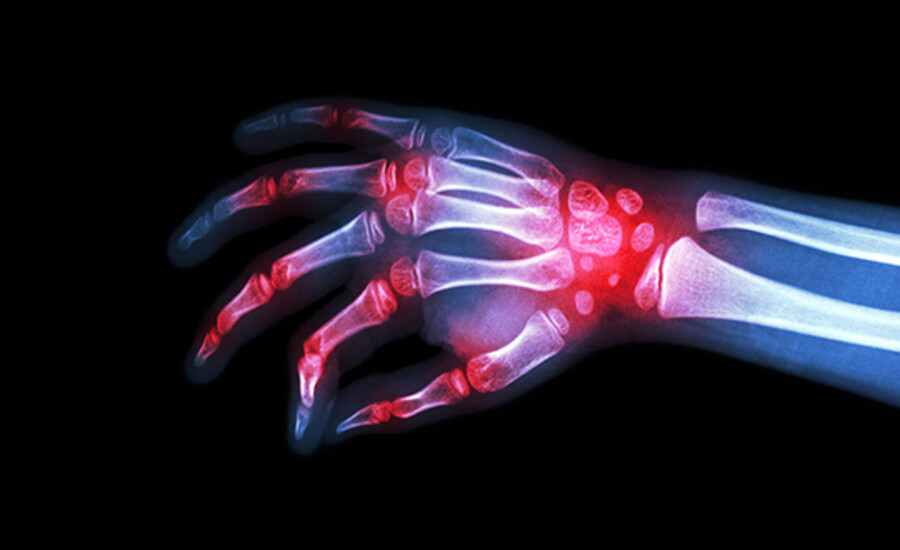 Kommen Sie mit ihren schmerzenden Knochen klar  